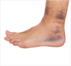 Ankle Sprains Bowden, 5007