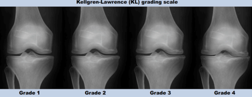 Kellgren-Lawrence (KL) grading scale
