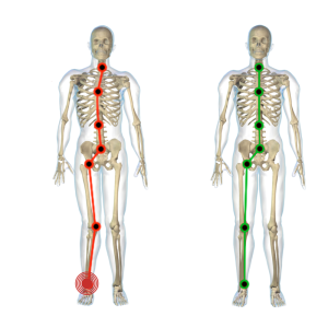 misalignment feet and body