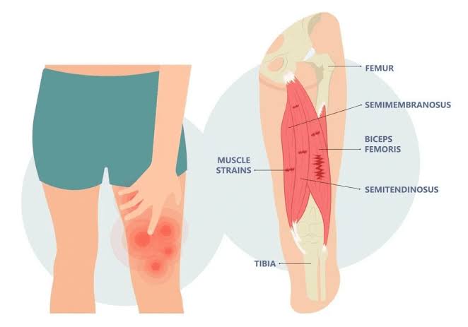 Hamstring Strain